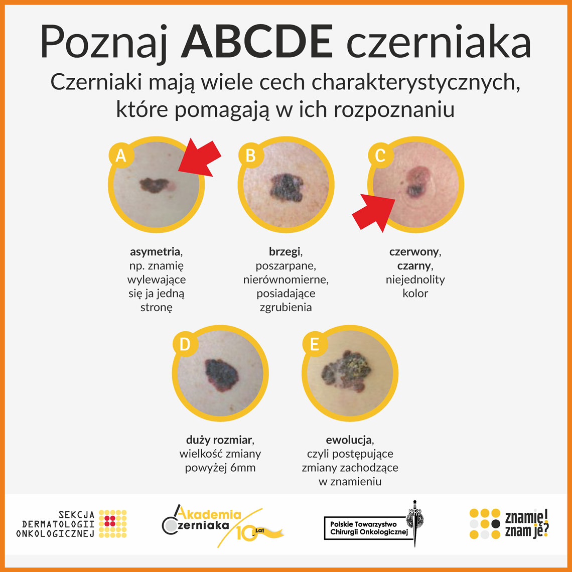 ABCDE czerniak